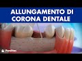 Corona dentale - Allungamento di corona clinica ©