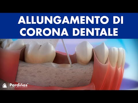 Video: Corona Temporanea: Vantaggi, Usi, Cura Del Cappuccio Dentale Temporaneo