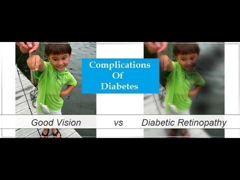 complications-of-diabetes-|-diabetic-complications-list