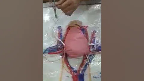 workshop uterine artery ligation and course of ureter.