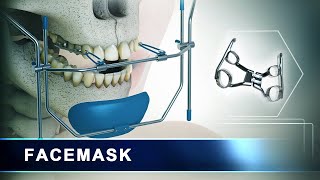 Facemask | Orthodontic Headgear Appliance | 3d Animation