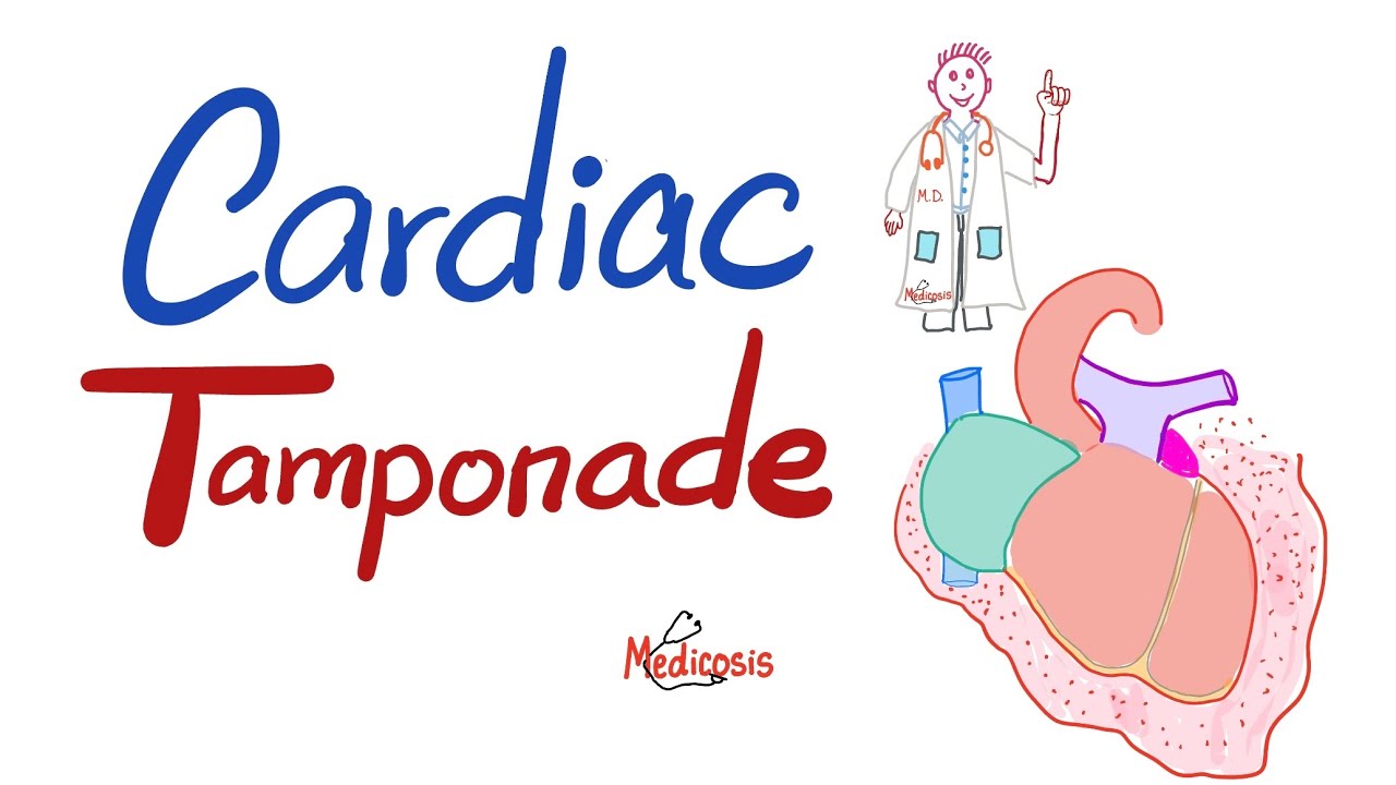 Cardiac Tamponade - Causes, Symptoms, Signs, Diagnosis & Treatment - Cardiology Series