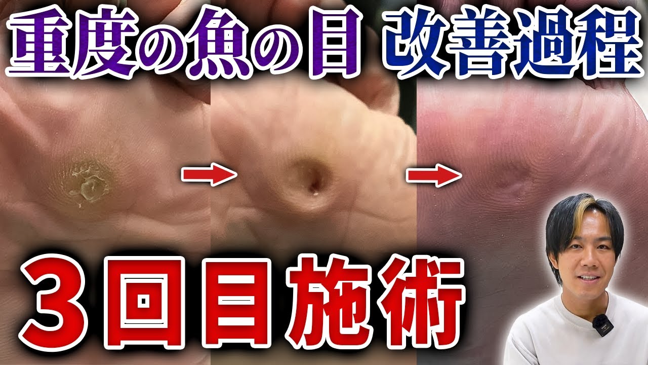 【施術経過】あなたは魚の目とタコの違いはわかりますか?違いは〇〇です - YouTube
