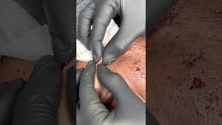 Part 4 Nevus Comedonicus