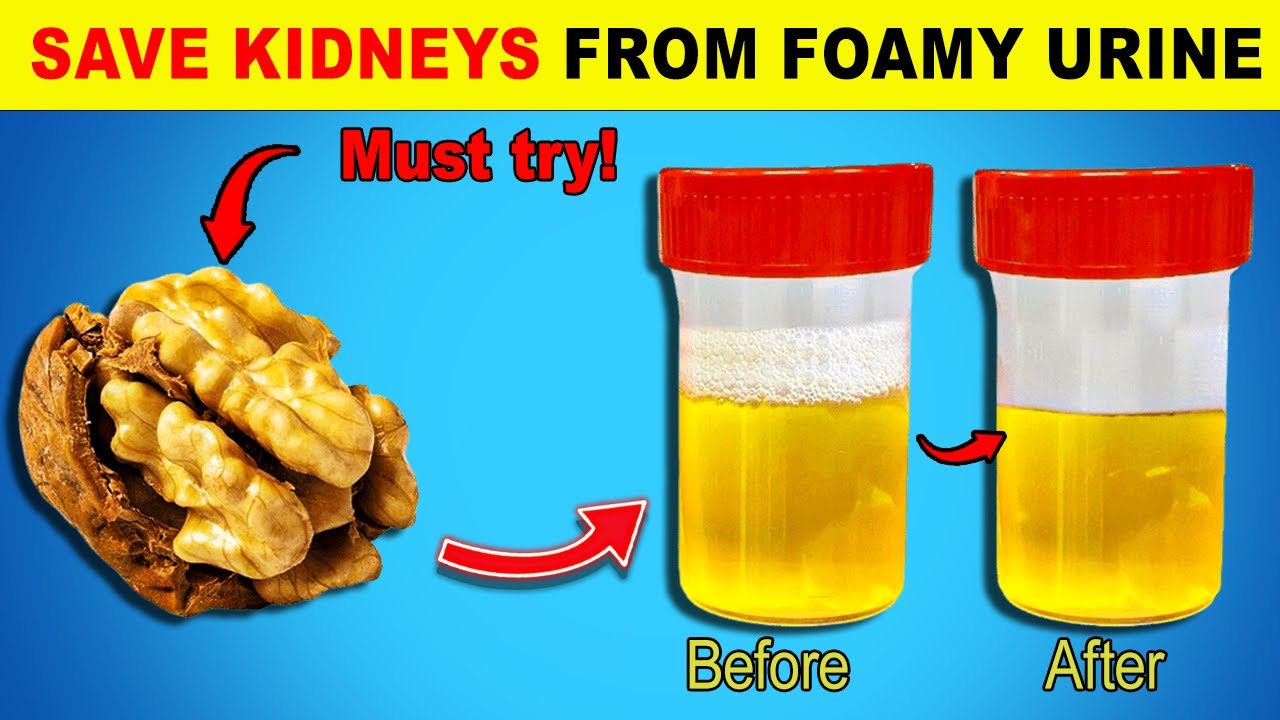 Top 6 Super Foods To Help Stop Proteinuria and Heal Your Kidneys ...