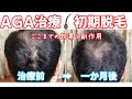 【治療1か月目】AGA治療の初期脱毛レポと副作用について【ハゲダス注意報】