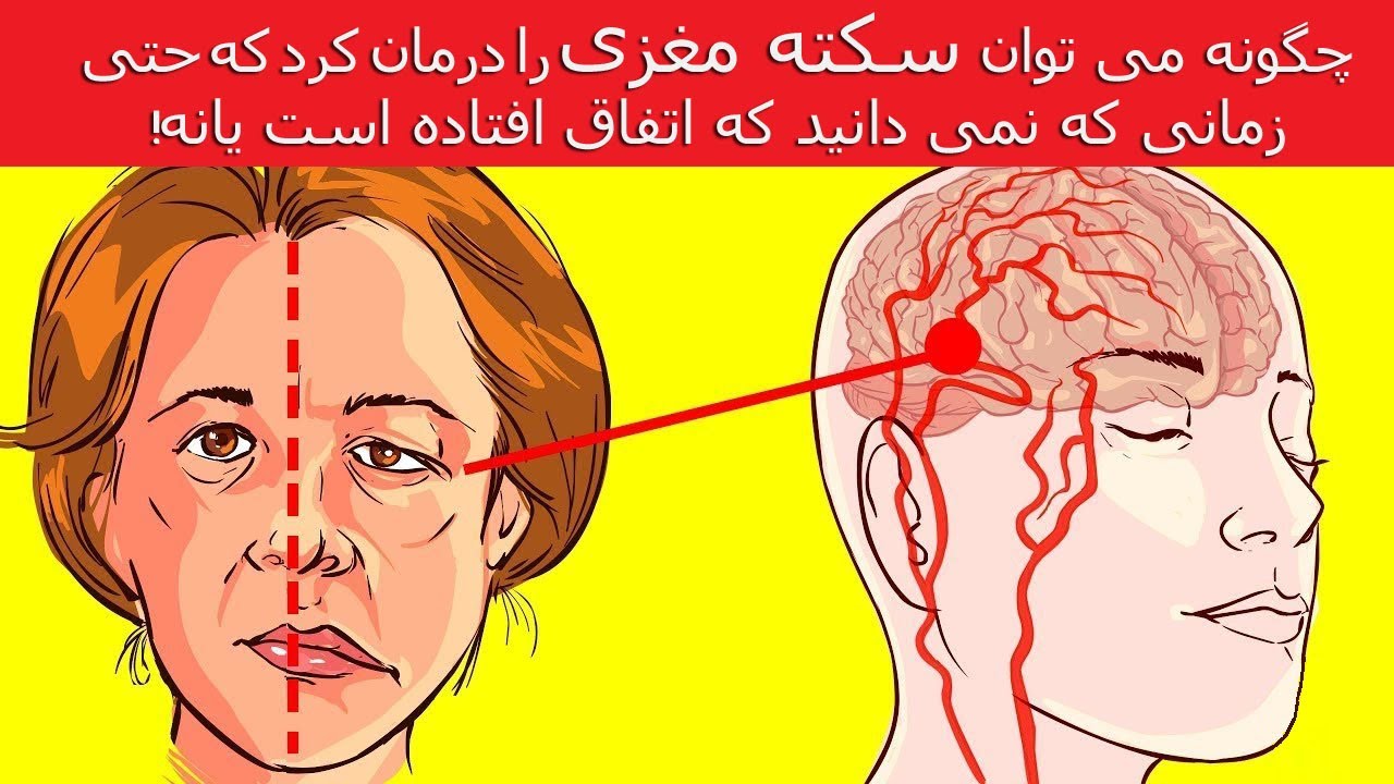 چگونه می توان سکته مغزی را درمان کرد که حتی زمانی که  نمی  دانید که  اتفاق افتاده است یانه