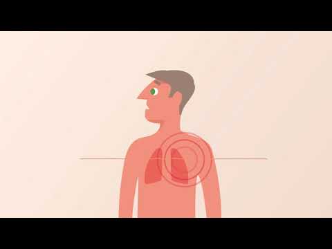 Video: Portale Veneuze Trombose (PVT): Symptomen, Oorzaken En Behandeling