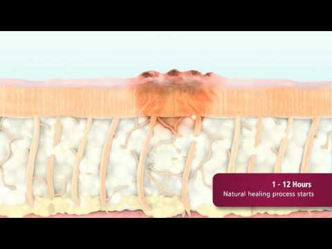 როგორ ხდება კანის აღდგენა/გაახალგაზრდავება ლაზერით