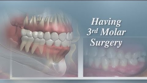 Having Third Molar Surgery