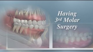 Having Third Molar Surgery