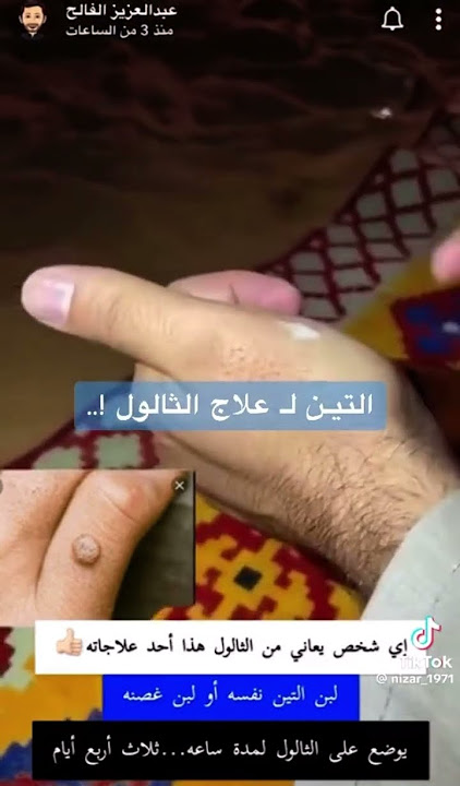 التين لعلاج الثالول وصفة صحيحة