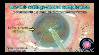 CataractCoach™ 3024: low IOP phaco settings cause a complication