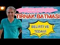 TIRNAK BATMASI,BELİRTİ,KORUNMA,TEDAVİ