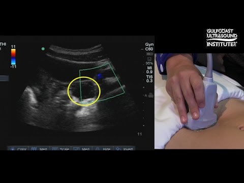 Hot Tips - Locating the Ovaries on Transabdominal Ultrasound