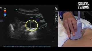 Hot Tips - Locating the Ovaries on Transabdominal Ultrasound