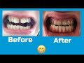 Braces: Before and After (0-27 Months Time Lapse)