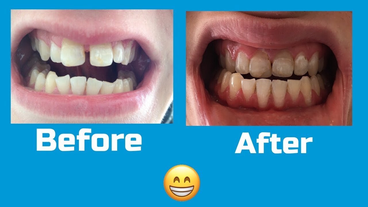 Braces Before and After (027 Months Time Lapse) YouTube