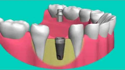 Periodontist implant dentist gum infection orange ...