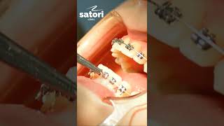 Лигатурные брекеты, установка дуг и лигатур  #orthodontist #брекеты #braces