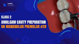 Class 2 Amalgam Cavity Preparation on Mandibular Premolar #29 |  Caapid Simplified Bench Prep Course