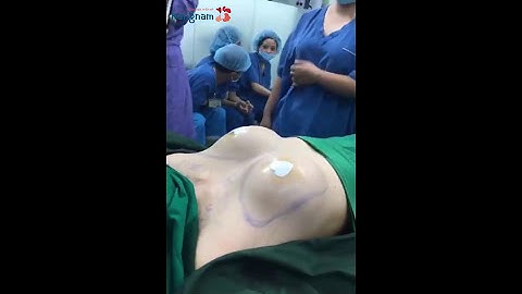 Cận cảnh phẫu thuật nâng ngực đặt túi khác Size tại Kangnam