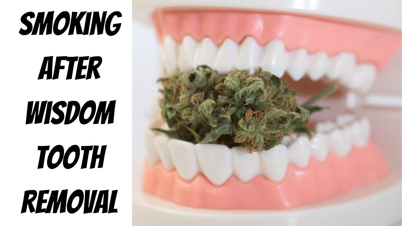 SMOKING AFTER WISDOM TOOTH REMOVAL YouTube