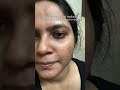 The Unreal Skin Transformation Hit Subscribe Skincare Acne Trendingshorts Clearskin Kurti 
