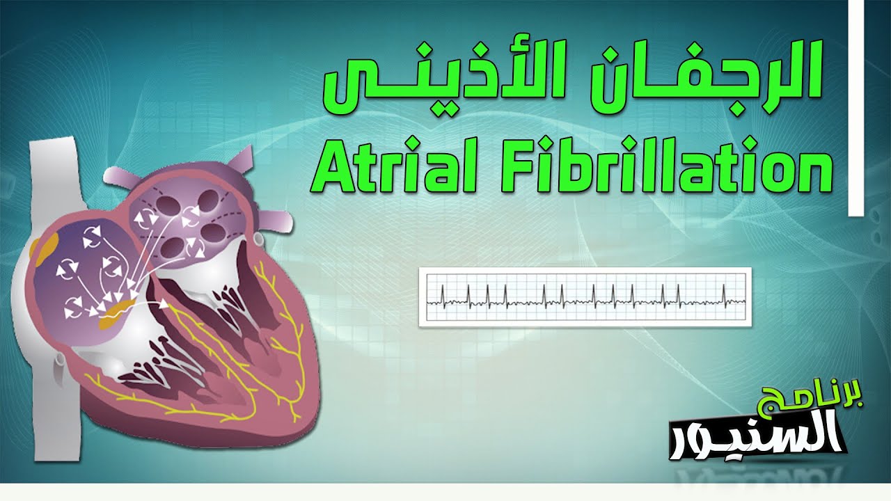 الرجفان الأذينى | Atrial Fibrillation