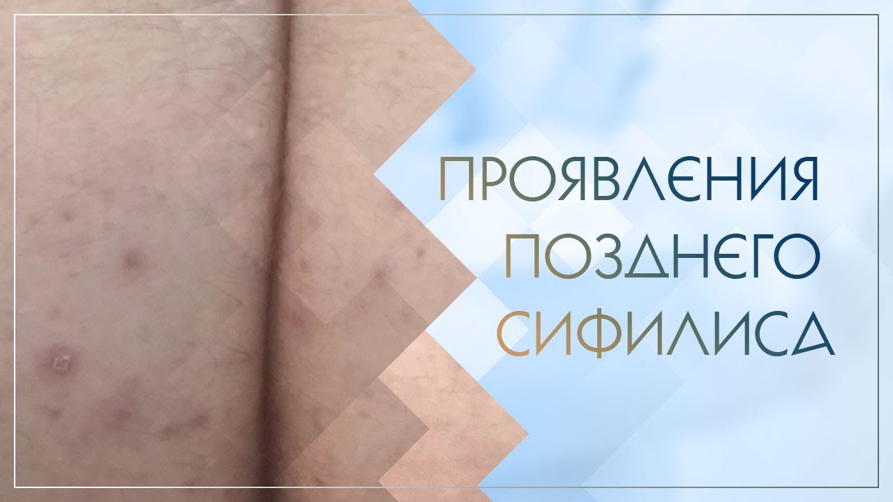 💣 Проявления позднего сифилиса. Клинический случай №23 - YouTube