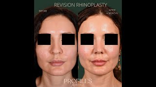 Celebrity Revision Rhinoplasty - how accurate is computer imaging? Profile