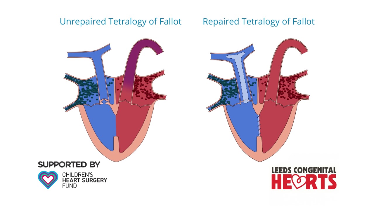 Tetralogy Of Fallot Repair YouTube Tetralogy Of Fallot Repair YouTube