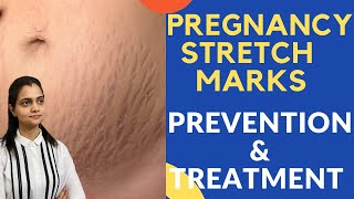 Stretch Marks Treatment Stretch Marks Removal Treament Dr. Mayuri Kothiwala, Jaipurt