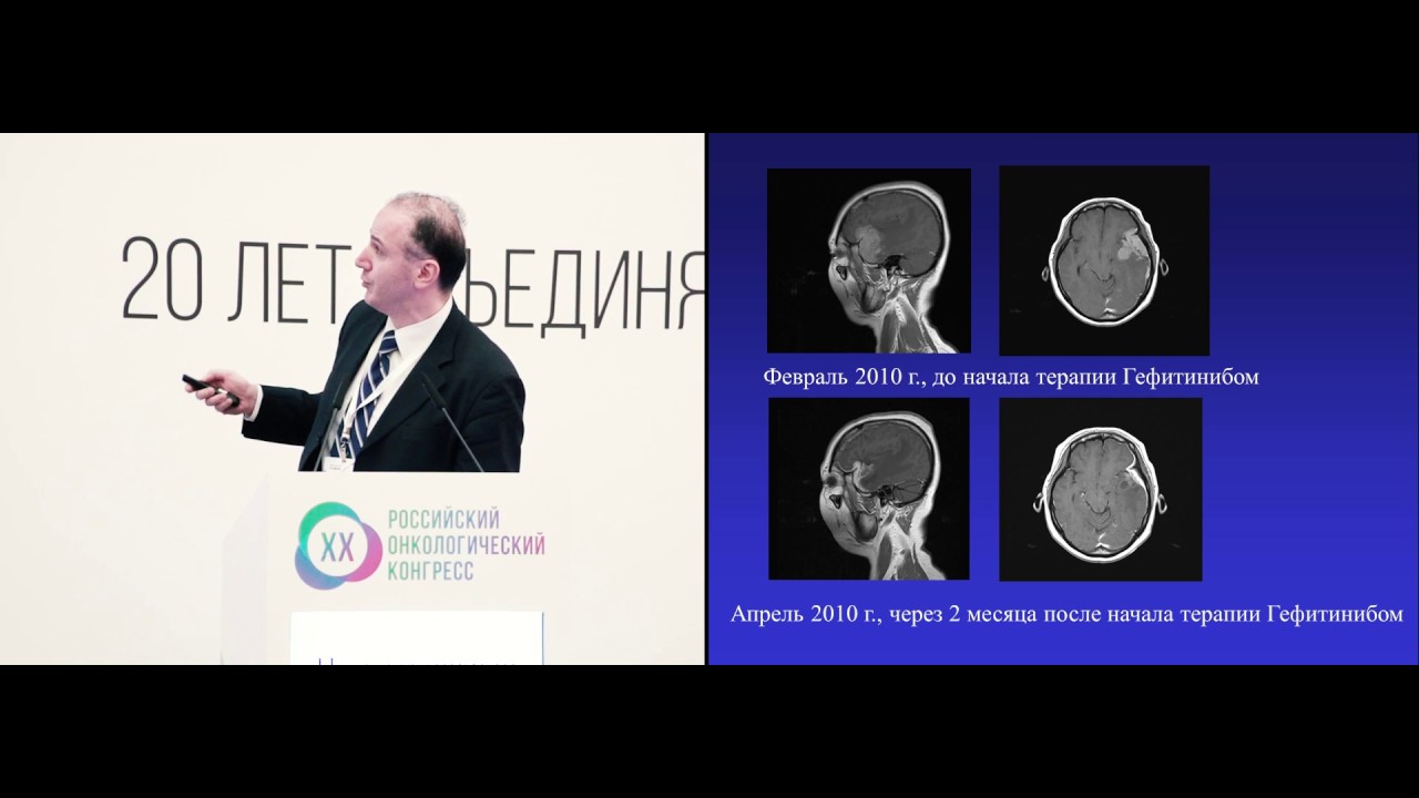 Таргетная терапия или облучение всего головного мозга при множественных ...