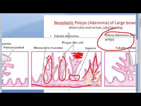 Video: Tubularni Adenom: Opredelitev, Zdravljenje, Obeti In Drugo