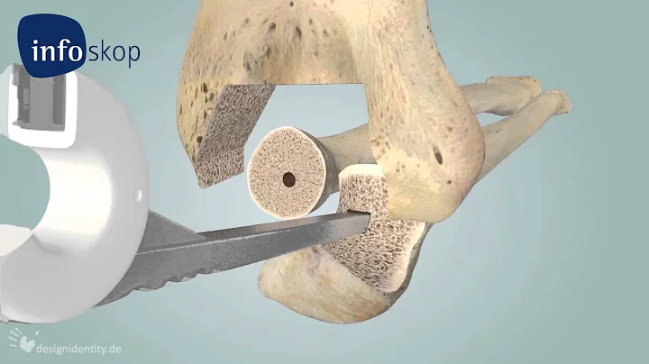 3D medical animation - Ellenbogen, Vollprothese - ...