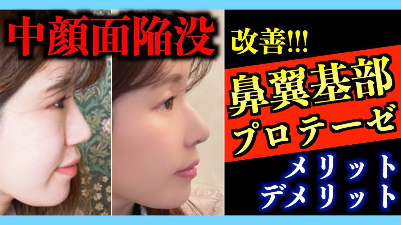 【鼻整形】鼻翼基部プロテーゼ（貴族手術）をした感想とメリット・デメリットを解説します。