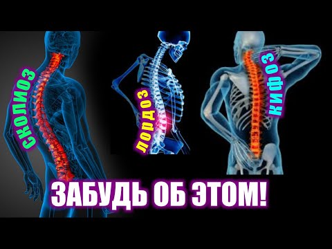КАК ИСПРАВИТЬ КРИВИЗНУ ПОЗВОНОЧНИКА |ЛОРДОЗ, КИФОЗ И СКОЛИОЗ. (лечение и исправление осанки)