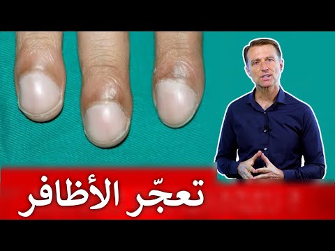 الأظافر التي تدل على مشاكل خفية مثل أمراض الكبد والقلب