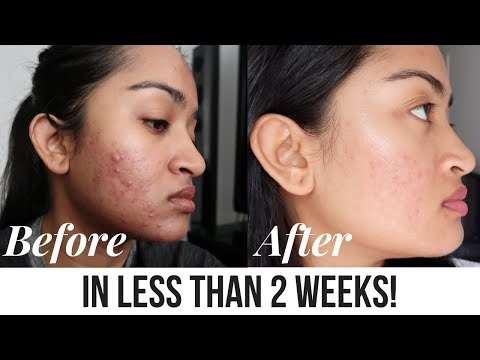 Acne Treatment Facial Peel + Before and After | SilasQiu