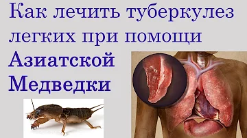Как применять медведку при лечении туберкулеза легких