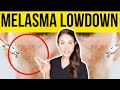 Get The Lowdown On Melasma From A Dermatologist