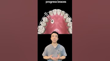 Niềng răng kéo răng ngầm #nhakhoaquocteachau #invisalign #topdental