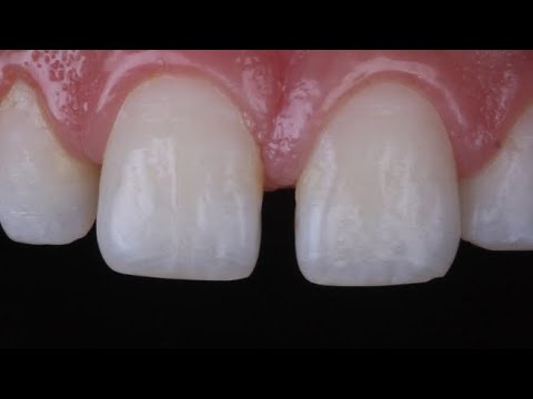 diastema closure with composite resin