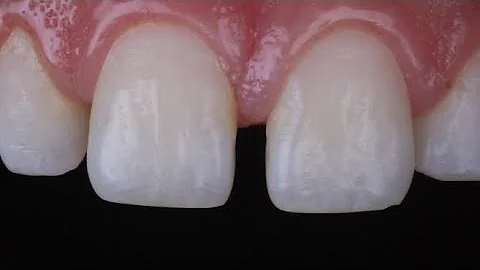 diastema closure with composite resin