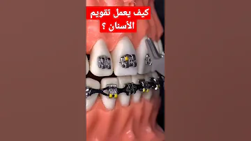 شاهد بنفسك كيف يعمل تقويم الأسنان بسرعة وبدون ألم ونتائج سحرية لا تصدق الحصول على ابتسامة جميلة 