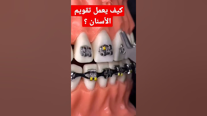 شاهد بنفسك كيف يعمل تقويم الأسنان بسرعة وبدون ألم ونتائج سحرية لا تصدق الحصول على ابتسامة جميلة