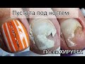 ПУСТОТА ПОД НОГТЕМ😱Такого ещё не видела😢Треш-контент💥ПОСЛЕ ПОХОДА К ХИРУРГУ🙈Что делать⁉️