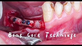 carrot technique applied in horizontal bone augmentation 骨柱技术在水平向骨增量中的应用