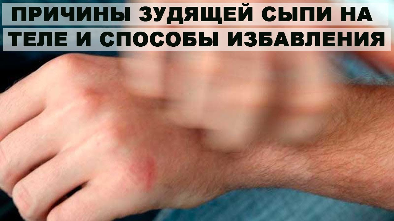 СЫПЬ.КОЖНЫЙ ЗУД.КРАСНЫЕ ПЯТНА НА ТЕЛЕ.СПОСОБЫ ИЗБАВЛЕНИЯ.
